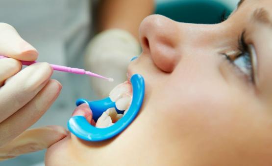 Фторирование зубов у детей глубокое по доступной цене в стоматологической клинике Vitart